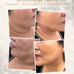 PCL (Polycaprolactone) Lifting