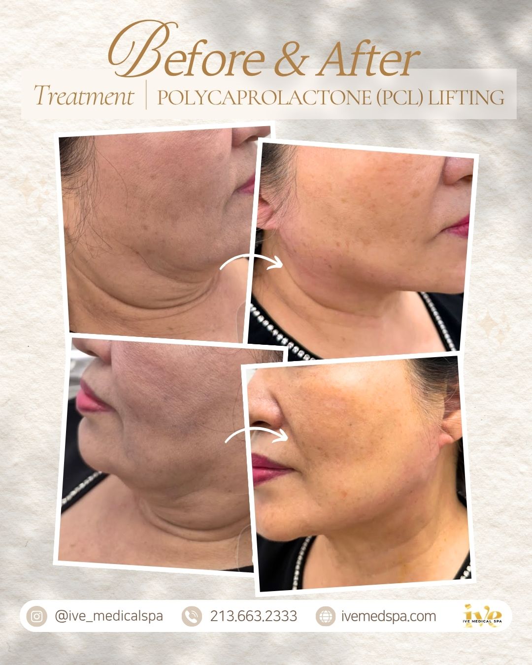 PCL (Polycaprolactone) Lifting