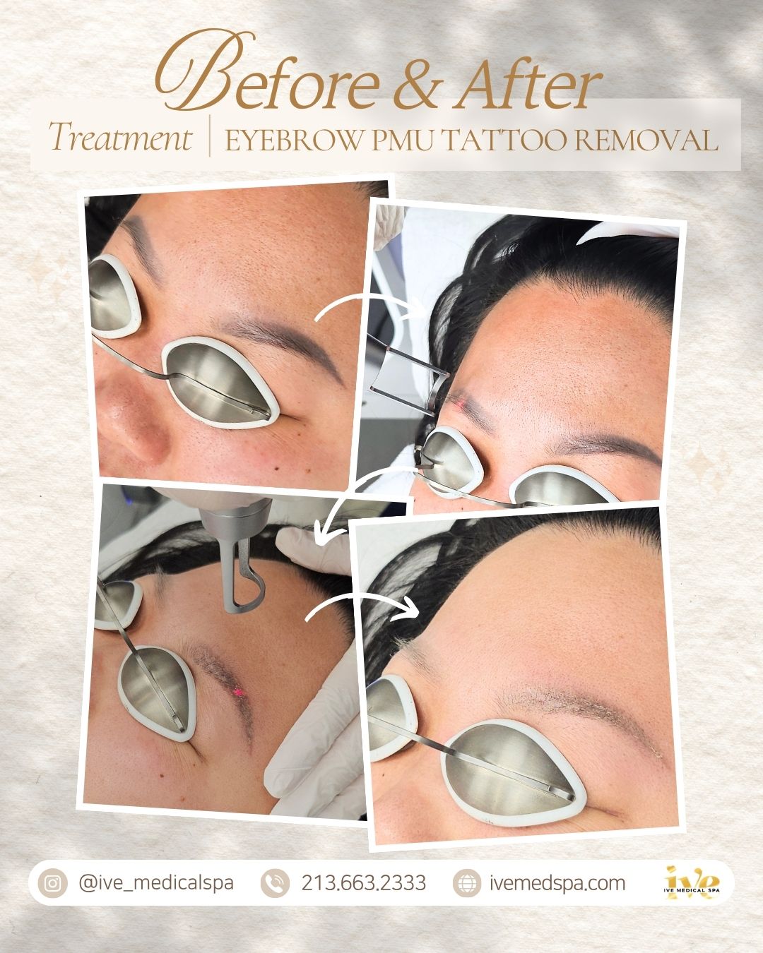 Old eyebrow PMU tattoo removal