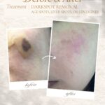 Dark Spot Removal