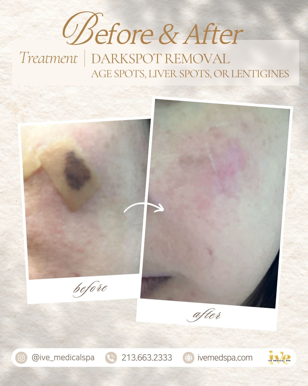 Dark Spot Removal