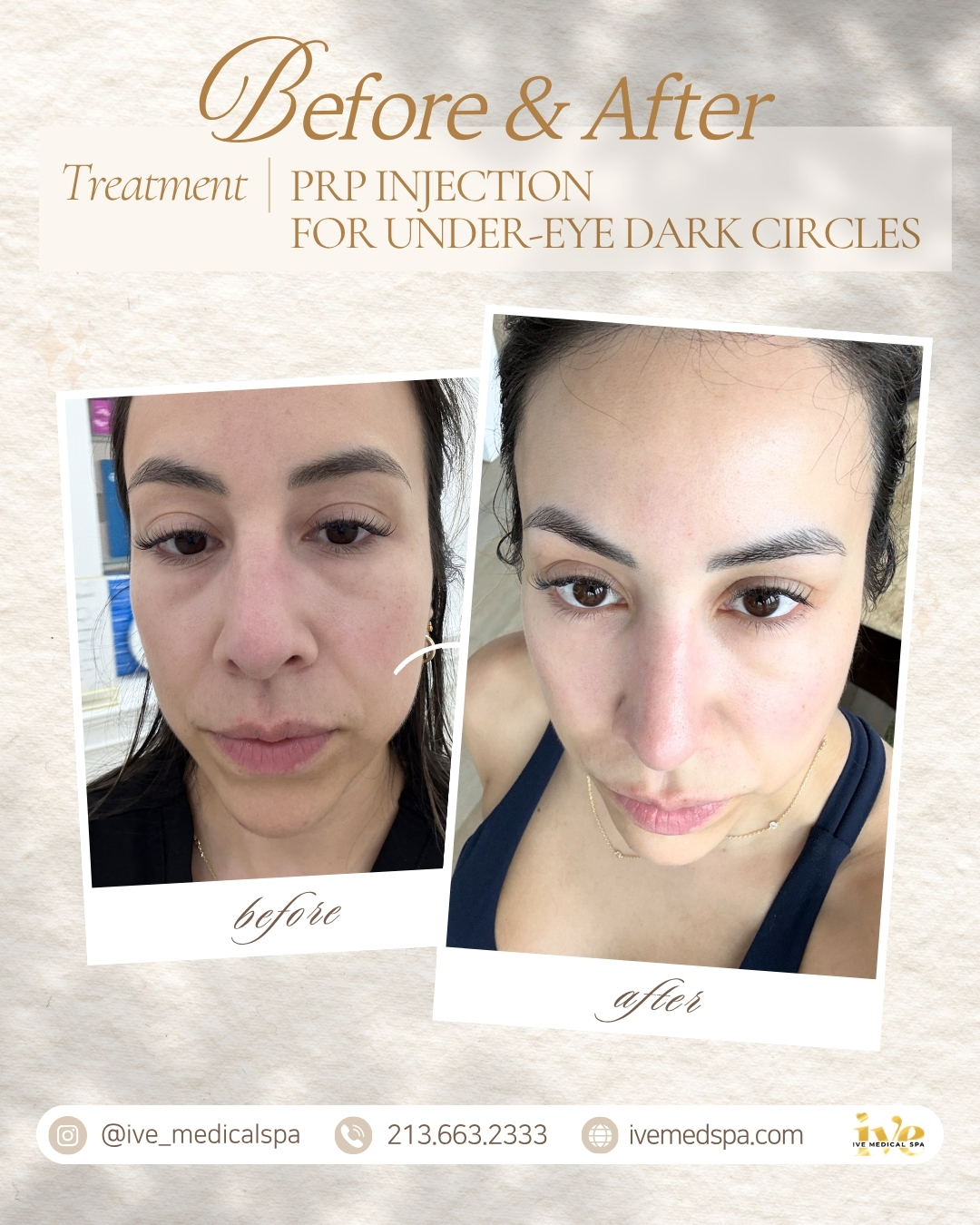 PRP Injection for Under-Eye Dark Circles