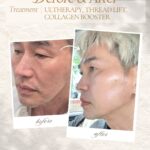 Ultherapy