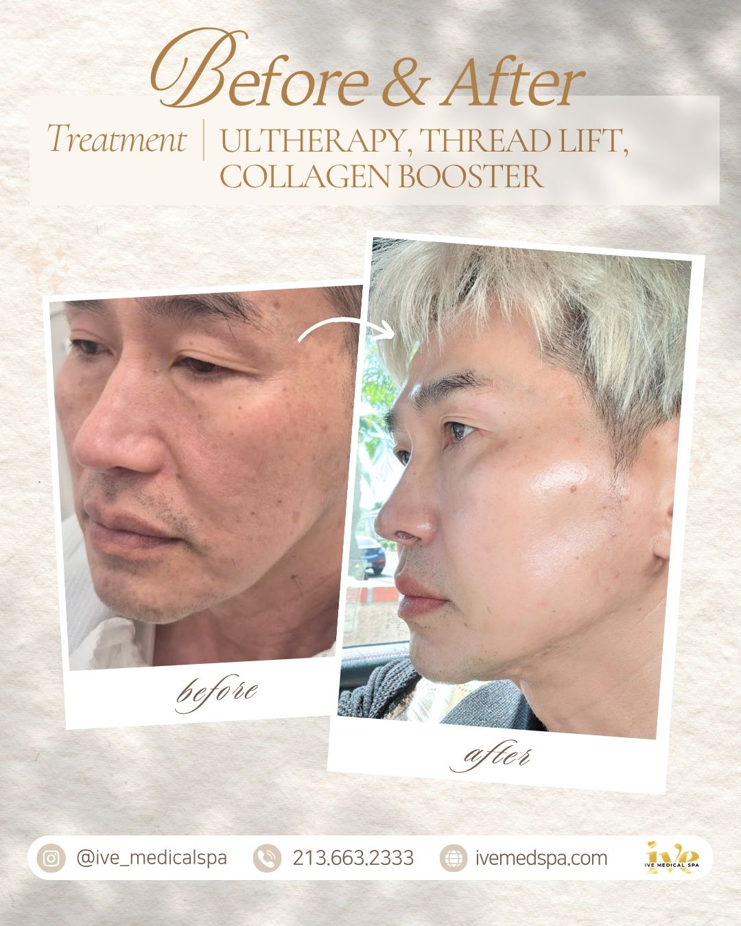 Ultherapy