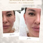 PCL thread lift
