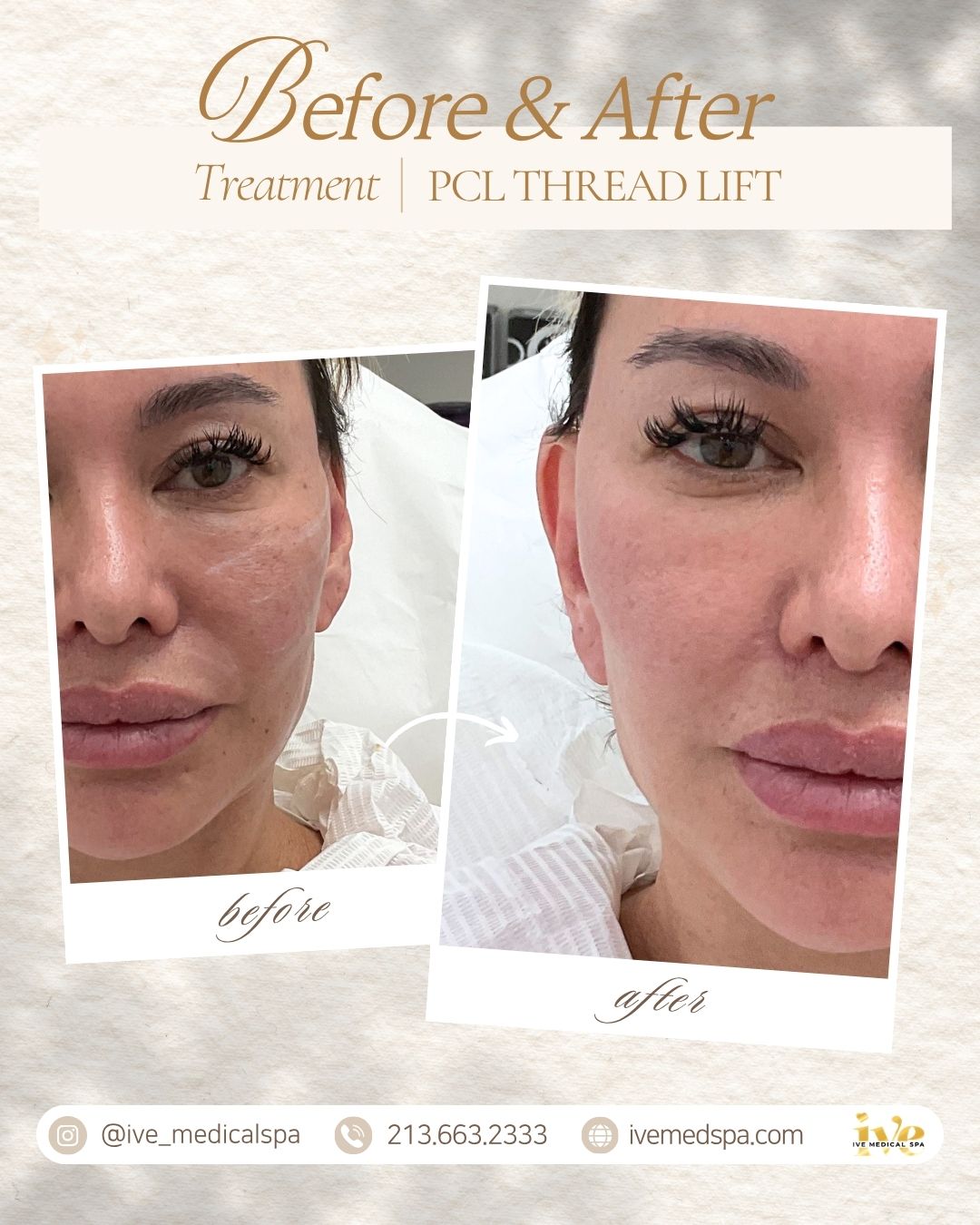 PCL THREAD LIFT, A more defined jawline