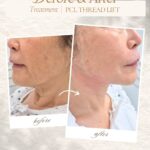 PCL thread lift (2)