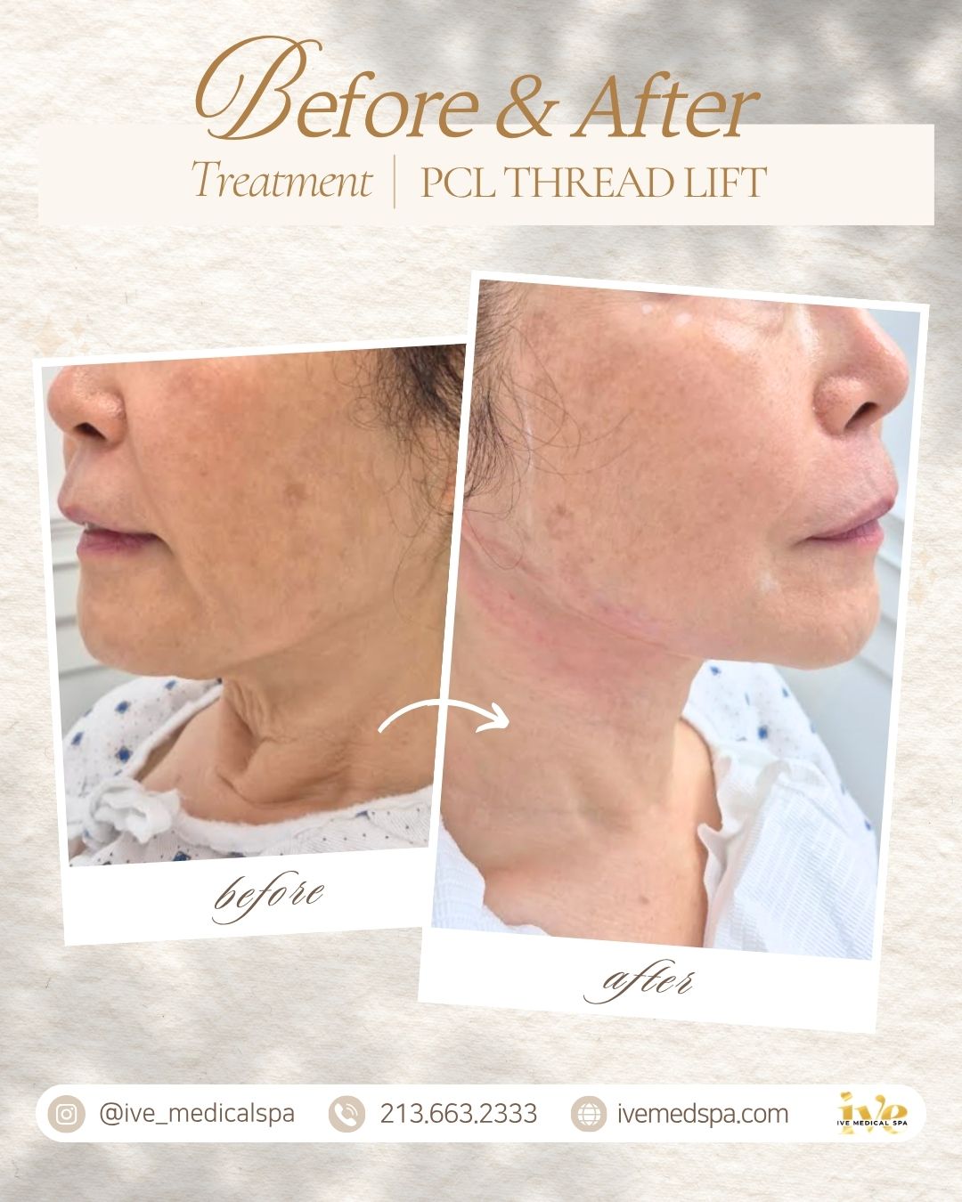 PCL THREAD LIFT, Lift. Support. Renew.